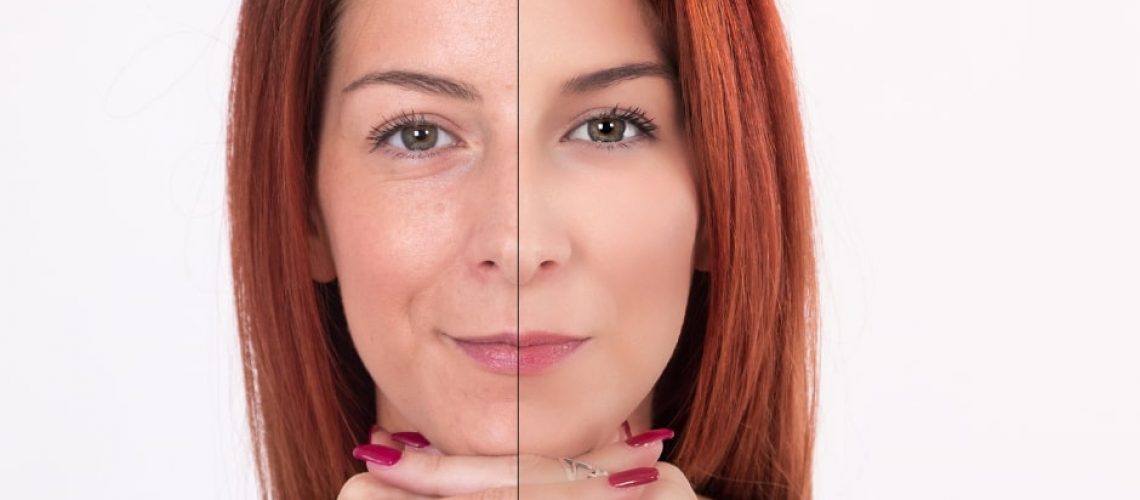 Before and After signs of aging | Resurgence Wellness in Arlington, TX