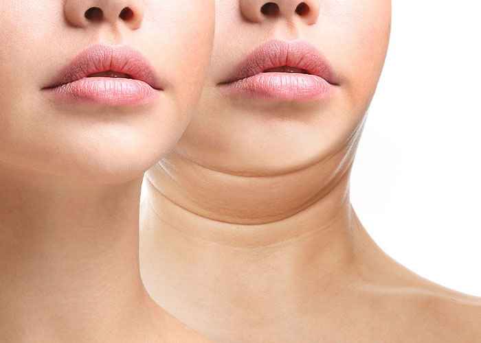 Before and After Cosmetic Injectables on neck | Resurgence Wellness in Arlington, TX